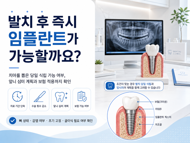 발치 후 바로 임플란트 심어도 될까요? 즉시 임플란트 식립이 가능한 경우와 주의할 점 대표 이미지