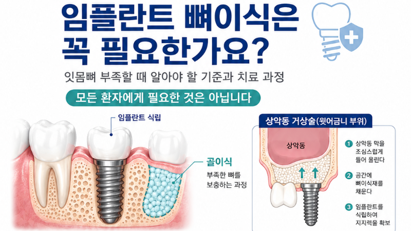 임플란트 뼈이식은 꼭 필요한가요? 잇몸뼈 부족할 때 알아야 할 기준과 치료 과정 대표 이미지