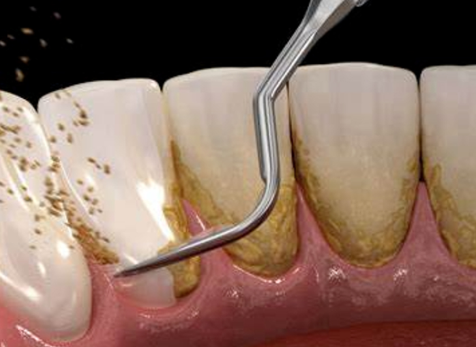 임플란트 부분틀니 임플란트 보철