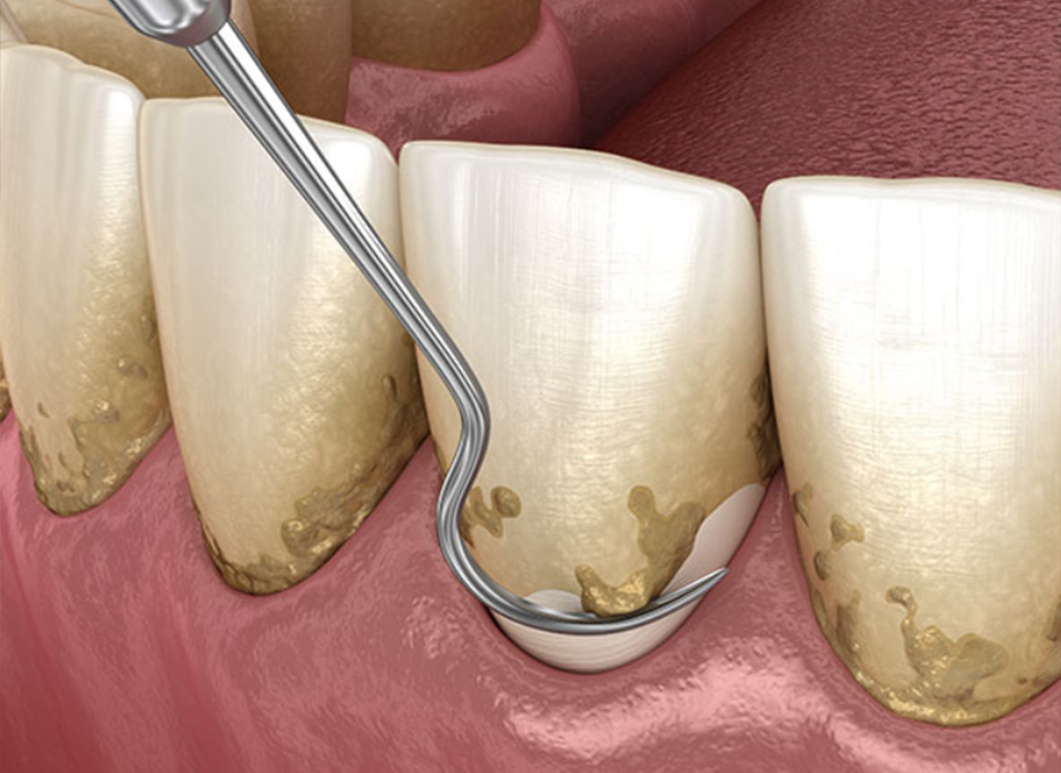 임플란트 부분틀니 임플란트 보철