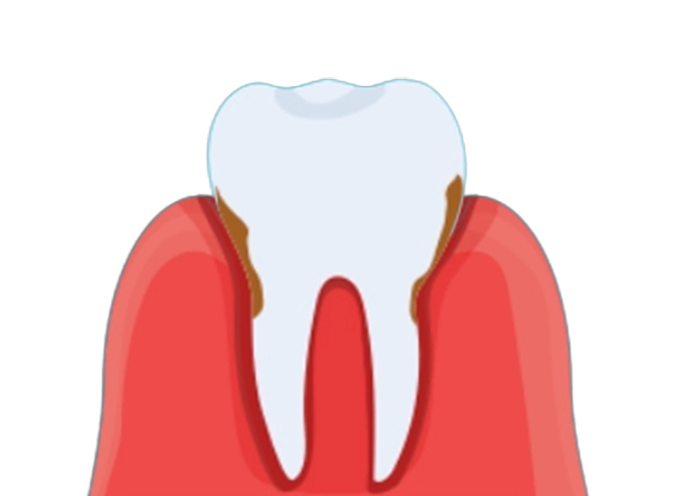 임플란트 부분틀니 임플란트 보철