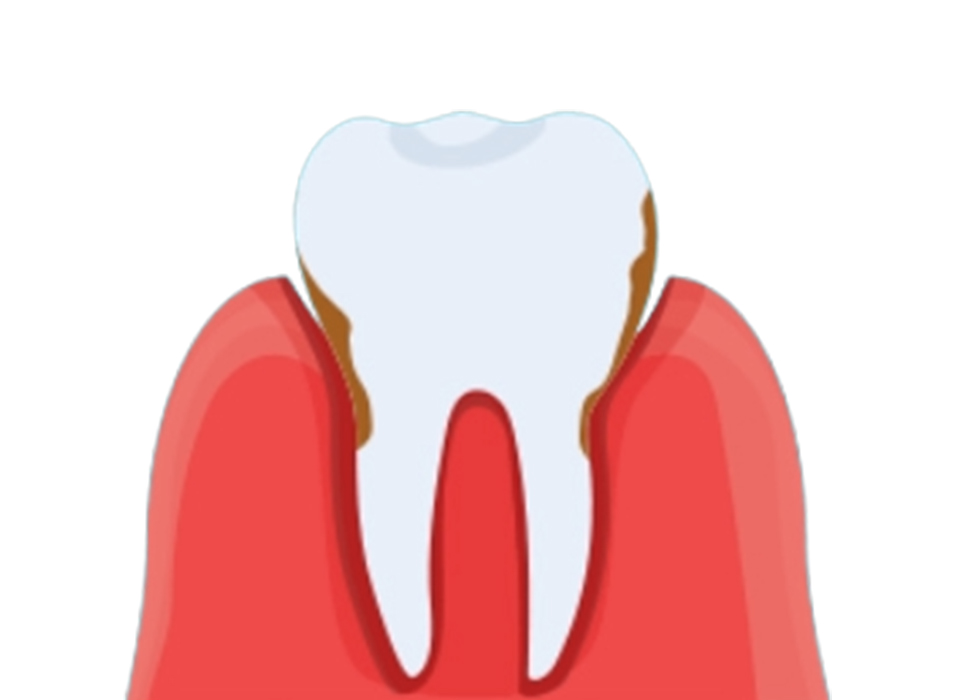 임플란트 부분틀니 임플란트 보철