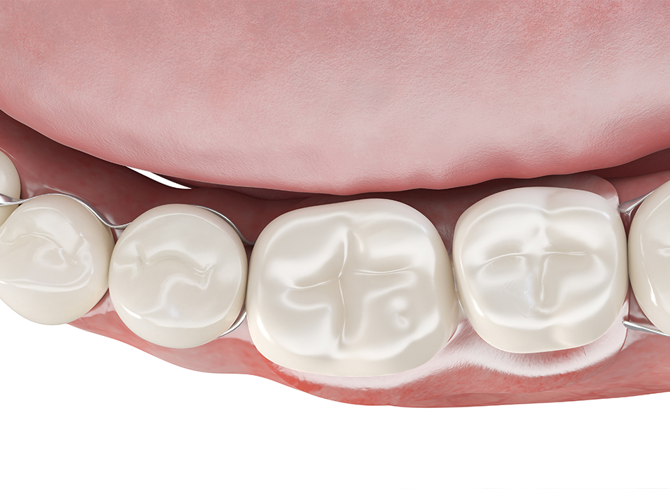 임플란트 부분틀니