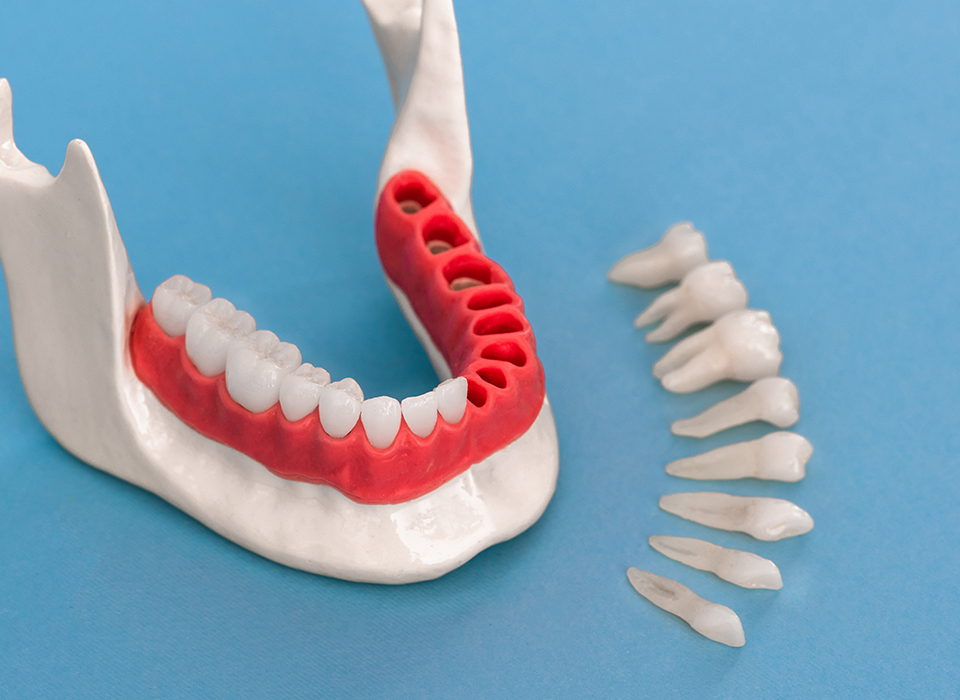 임플란트 부분틀니 임플란트 보철