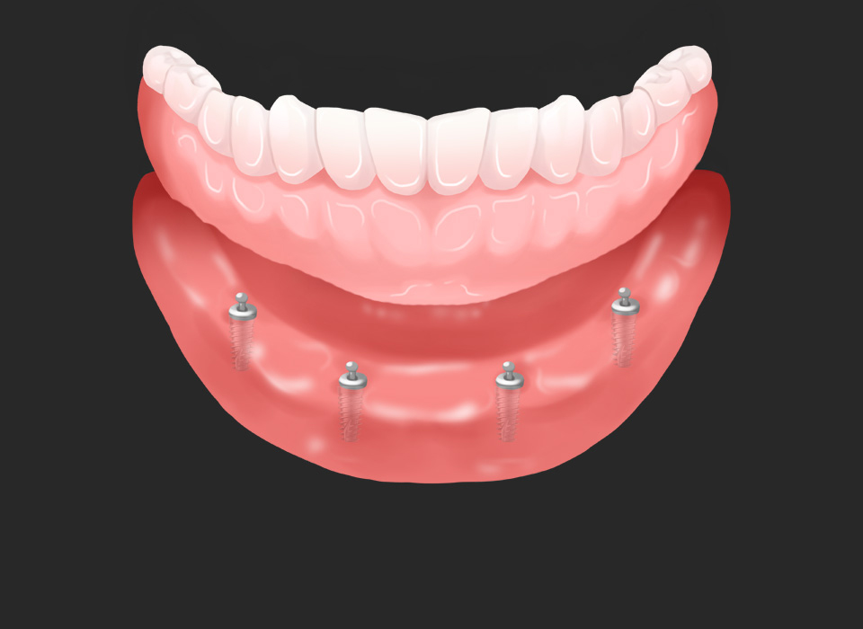 임플란트 부분틀니 임플란트 보철