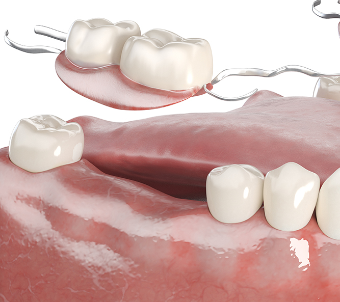 임플란트 부분틀니 이미지