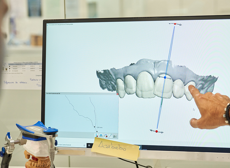 라미네이트 보철 라미네이트 보철