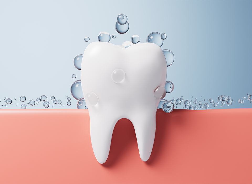 라미네이트 보철