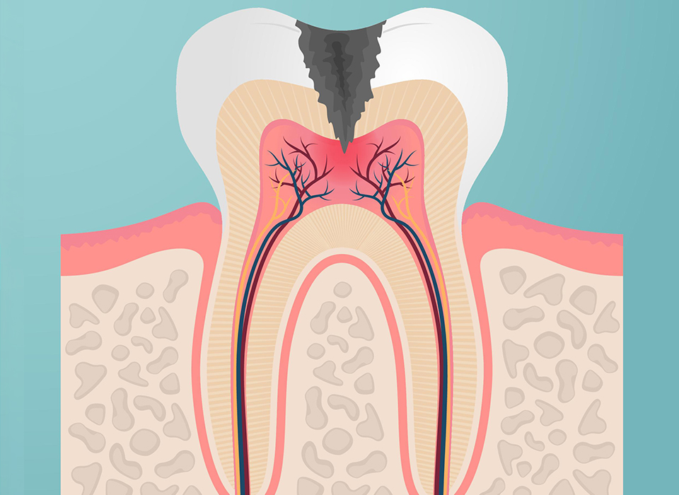 임플란트 부분틀니 임플란트 보철