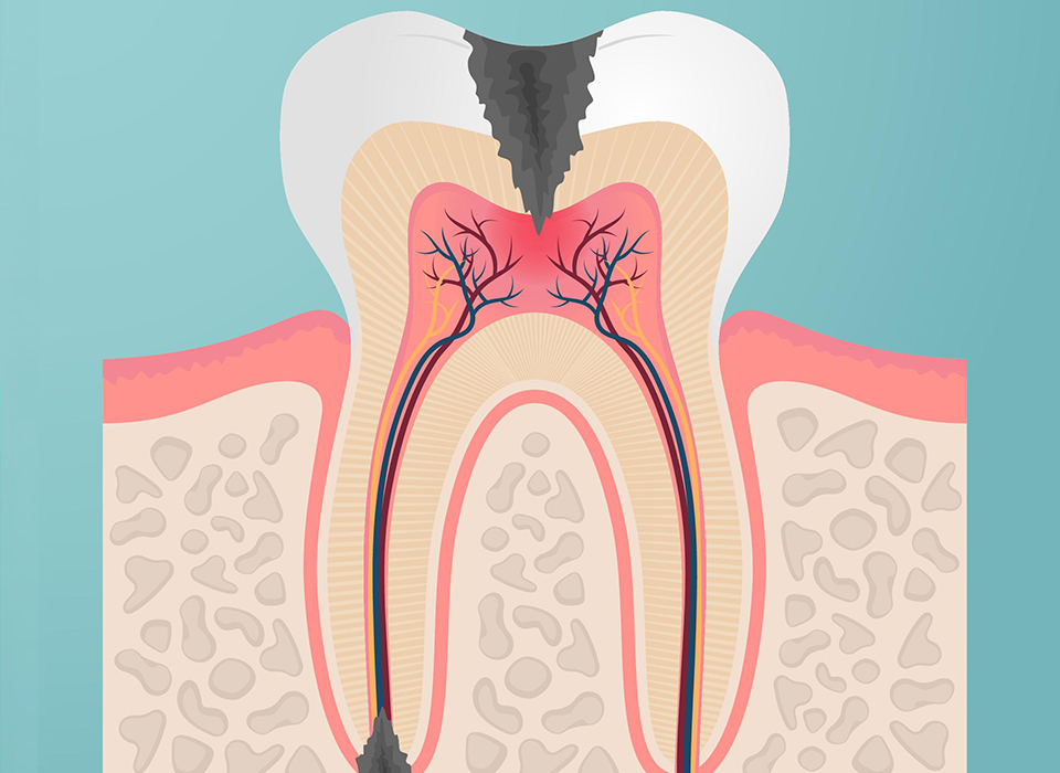 임플란트 부분틀니 임플란트 보철