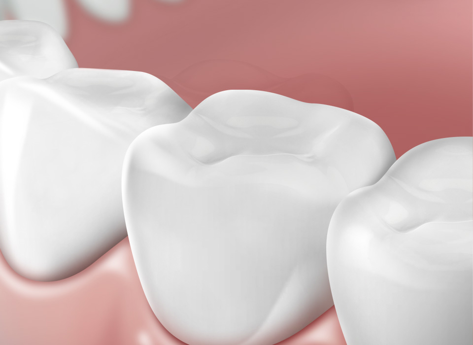 임플란트 부분틀니 임플란트 보철