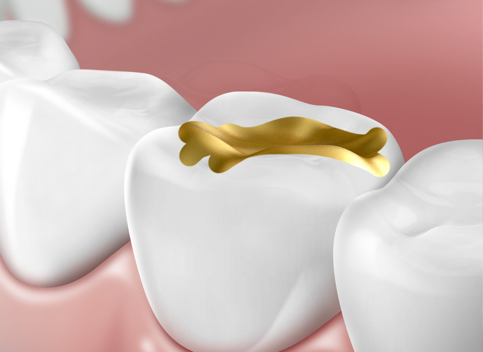 임플란트 부분틀니 임플란트 보철