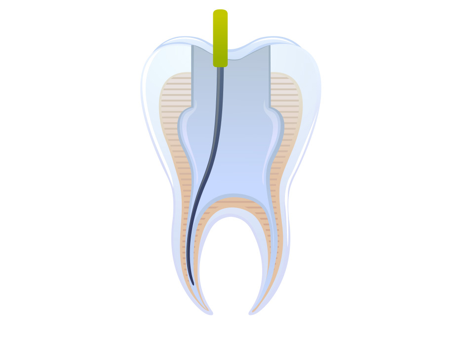 임플란트 부분틀니 임플란트 보철