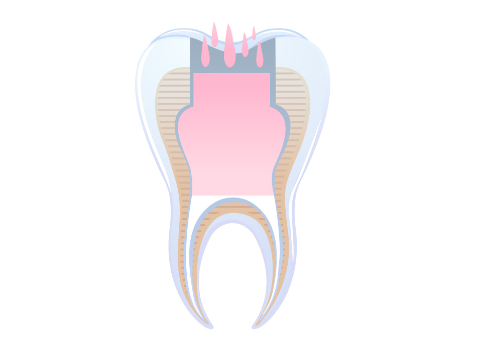 임플란트 부분틀니 임플란트 보철
