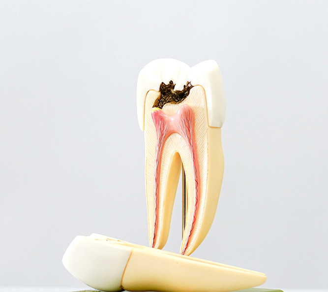 신경치료 이미지